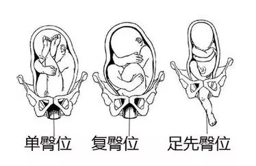 胎儿胎位异常