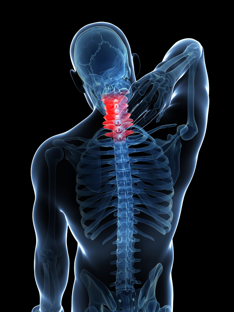 脊髓型颈椎病的特点