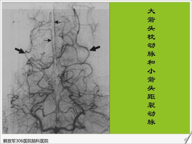 全脑血管造影图医学图库