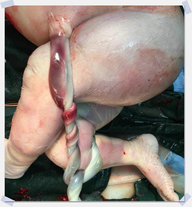 发生死亡,这时胎儿仍在宫腔内,称为死胎,俗称胎死腹中