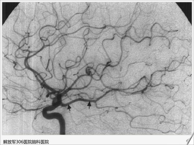全脑血管造影图医学图库