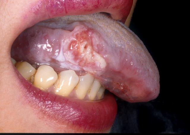 舌体溃疡反复不愈是怎么回事