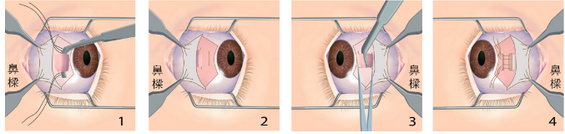 斜视手术 手术一般是治疗斜视的较后一步,透过改变眼球肌肉的松紧程