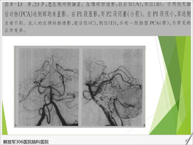 全脑血管造影图-医学图库