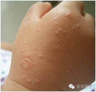 严重的沙土性皮炎,丘疹可融合呈苔藓样,向下肢扩散,泛发全身,瘙痒剧烈