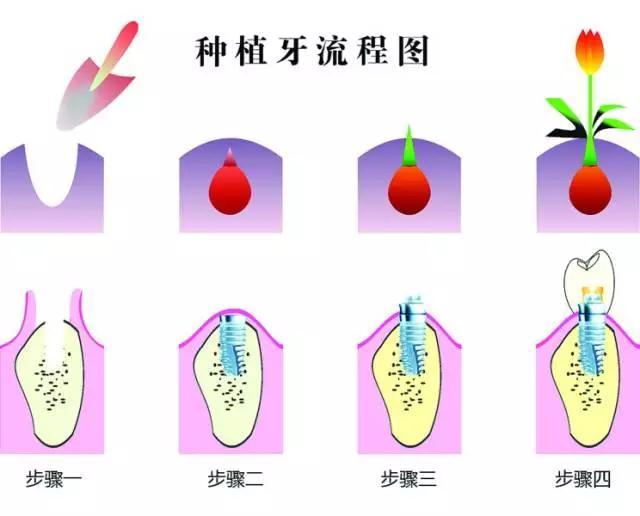 老人门牙掉了怎么办