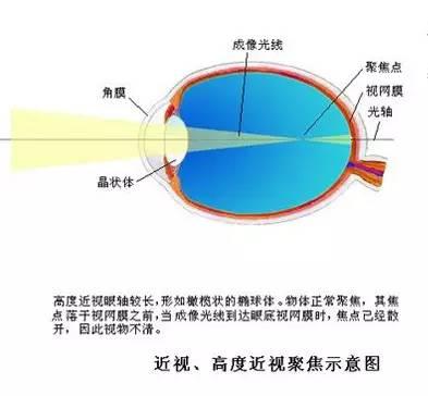 健康 正文  近视是指眼睛在调节静止状态下,平行光线进入眼内后,焦点