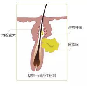 皮肤发红长痘怎么办