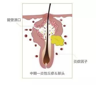 皮肤发红长痘怎么办