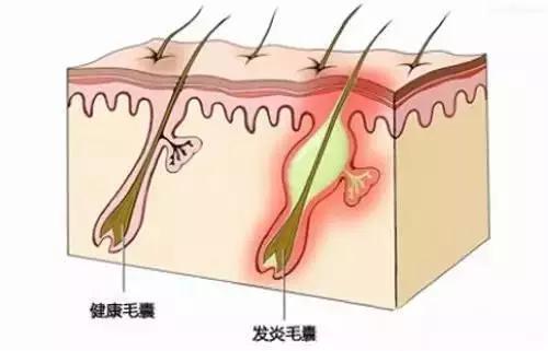 皮肤发红长痘怎么办