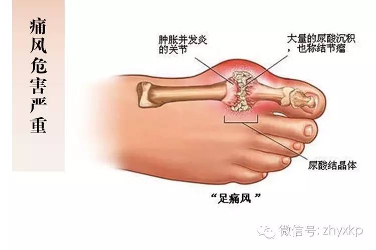 识痛风,痛在"大脚趾"