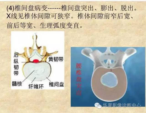 常见脊柱疾病的X线片分析