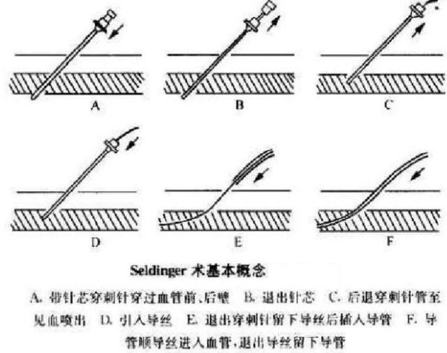 超声引导加塞丁格技术置入 POWER PICC的方