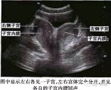 超声表现:子宫外形正常,但宫底横径较宽,宫底水平   双侧宫角分离在