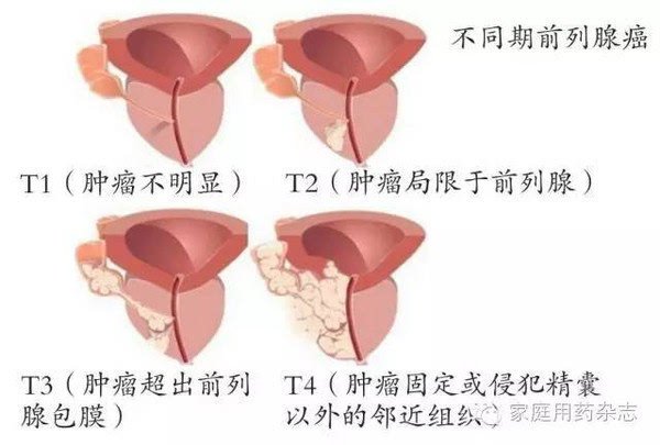肿瘤诊疗带来什么--访上海肿瘤医院泌尿外科主