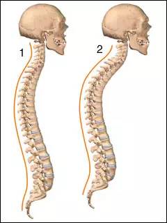 不正常的脊柱后凸(驼背)可以分为两种:功能性和结构性.