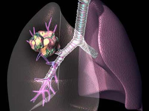 肺癌晚期病人口臭_肺癌晚期病人图片