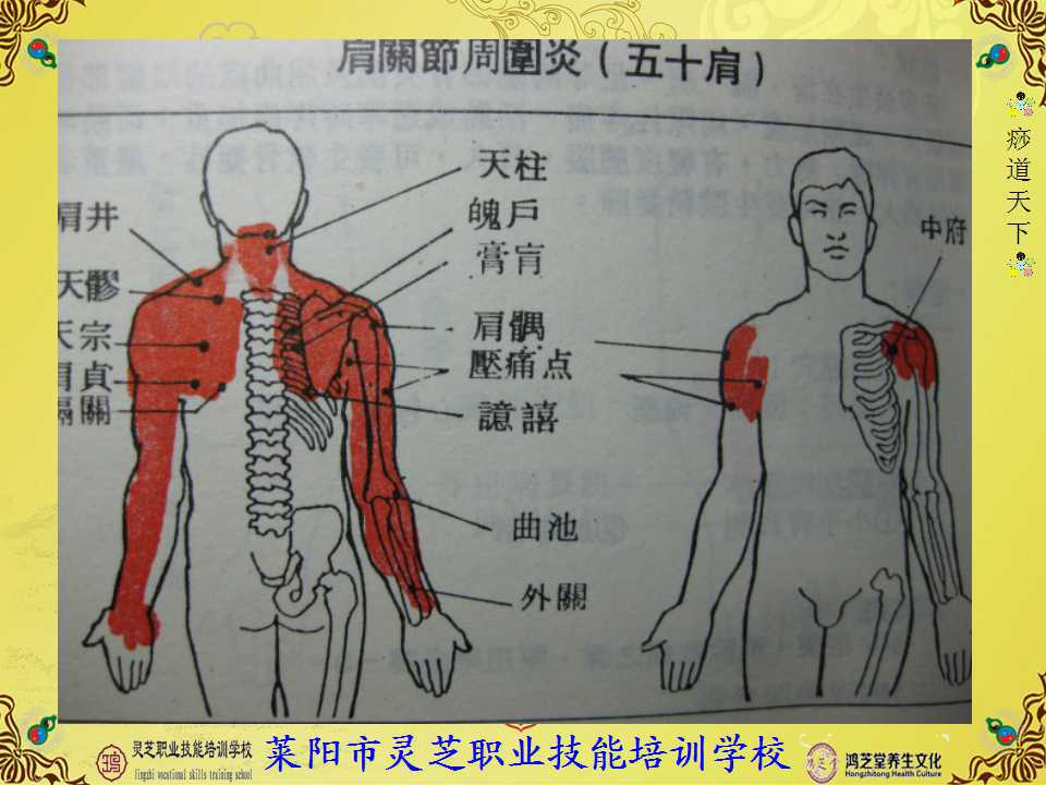 肩周炎刮痧理疗