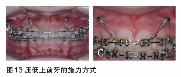 【病例分析】前牙深覆合伴露龈微笑典型病例【种植支抗】