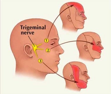 三叉神经痛是什么导致的?