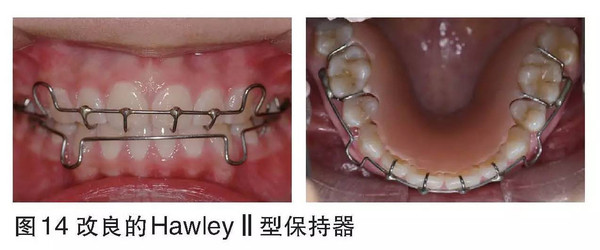 晚上戴用专门为前牙压低治疗设计的改良hawley Ⅱ型保持器(图14),即在