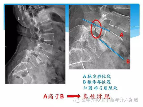 一眼看穿腰椎真性or假性滑脱