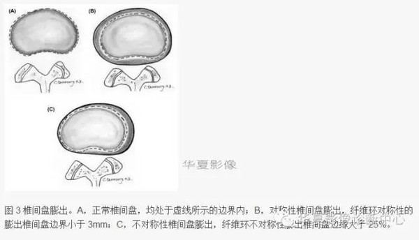 椎间盘膨出、突出、变性图解