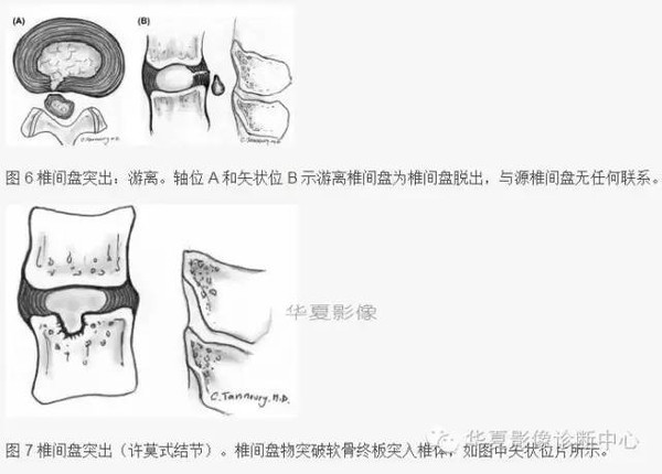 椎间盘膨出、突出、变性图解