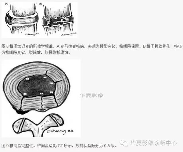 椎间盘膨出、突出、变性图解