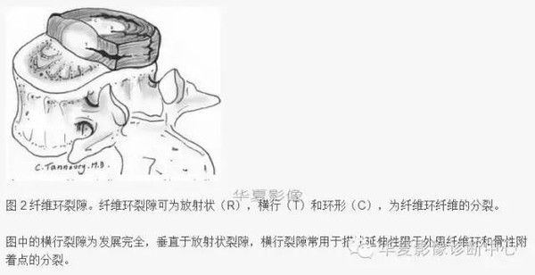 椎间盘膨出、突出、变性图解