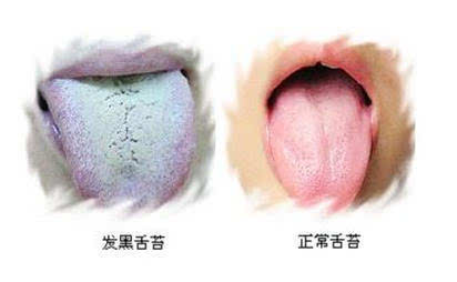 舌苔发黑 一是舌质红,舌苔发黑而干燥,甚至干裂,或生芒刺,为热邪极盛