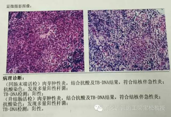 再次见到真正的肠结核