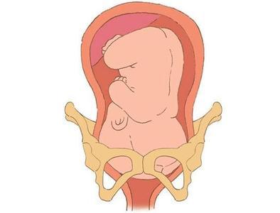 (3)产后子宫迅速下降到平肚脐的位置(在腹部用手可以摸到一个很硬并