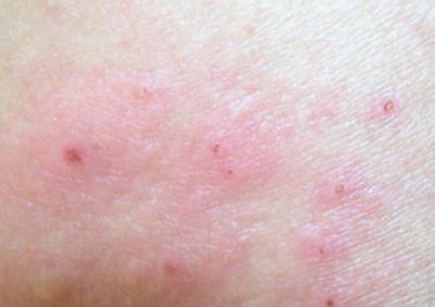 不同原因部位形成不同的湿疹 如何区分根治