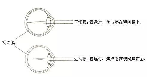 3d电影近视眼怎么办