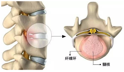 骨科专家魏美钢:90%腰椎间盘突出患者不需要手术