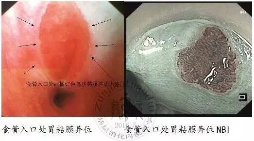 胃粘膜异位知多少