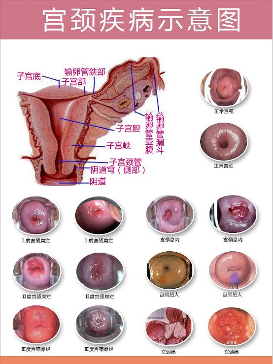 3.子宫过度后倾后屈