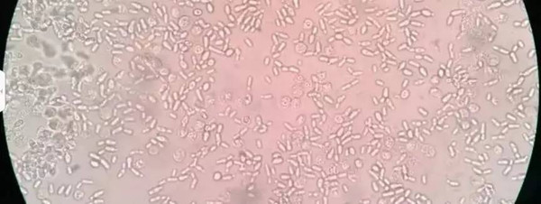 尿液标本(病人女,76岁,内科住院)显微镜镜下有大量真菌孢子,近乎满