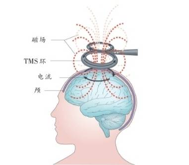 经颅磁刺激联合脑电图技术在意识障碍患者意识判别中的应用