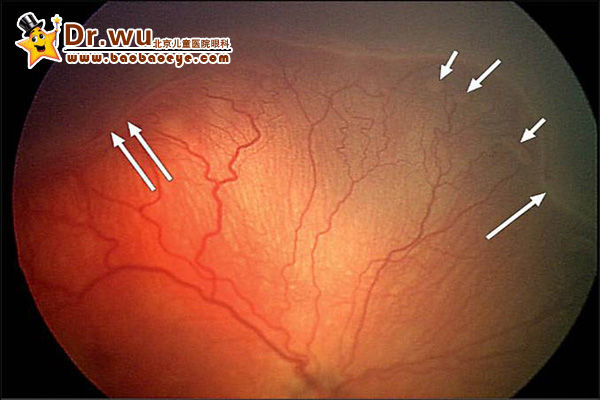 好爸科普2:早产儿视网膜病(ROP)-搜狐