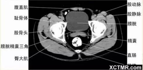 男性盆腔ct断层