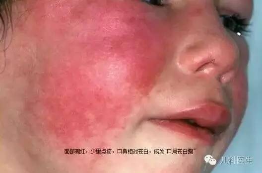 儿童常见皮肤病---猩红热