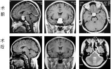 脑垂体瘤的规范诊治