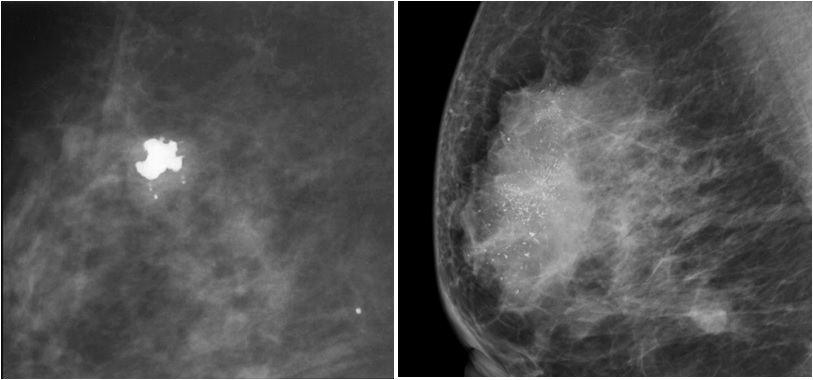 乳腺钼靶上看到钙化就是癌吗