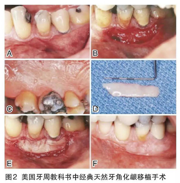 牙周膜龈手术改善种植条件—胡文杰教授