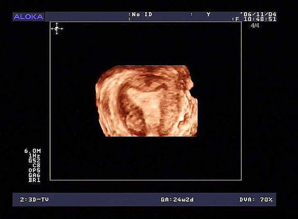 经阴道二维与三维子宫输卵管超声造影对输卵管通畅性的对比研究