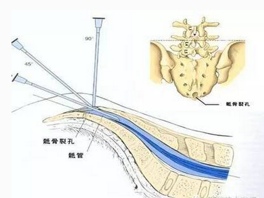 腰椎间盘突出症的骶管注射治疗