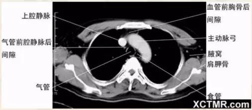 气管层面气管分叉层面奇叶-奇静脉弓-胸膜分布肺段划分肺窗胸部ct来源