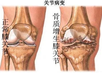 第二,膝盖骨质增生早期的症状主要表现为疼痛,不管患者是站着还是坐
